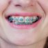 20 Cute Braces Colors & Color Combinations!