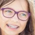 DIY Braces: 10 Reasons Why You Shouldn’t Do This | Ultimate Guide