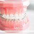 Are Power Chains The Last Step In Braces? Best Guide