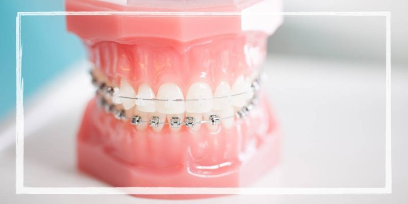 Power Chain Braces 19 Can You Get Power Chains When You First Get Braces?