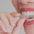 Food Getting Stuck in Teeth: Causes and Solutions