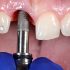 Do Dentists Lie About Cavities? How To Tell If I Need Treatment!