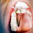 10 Causes Why Your Back Teeth Hurt When You Bite Down & Treatment!