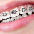 Most Popular Braces Color For Girls! Best Buying Guide