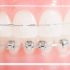 Are Power Chains The Last Step In Braces? Best Guide