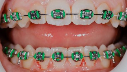 Teal Braces Color: Are They Good Fit? | Ultimate Guide