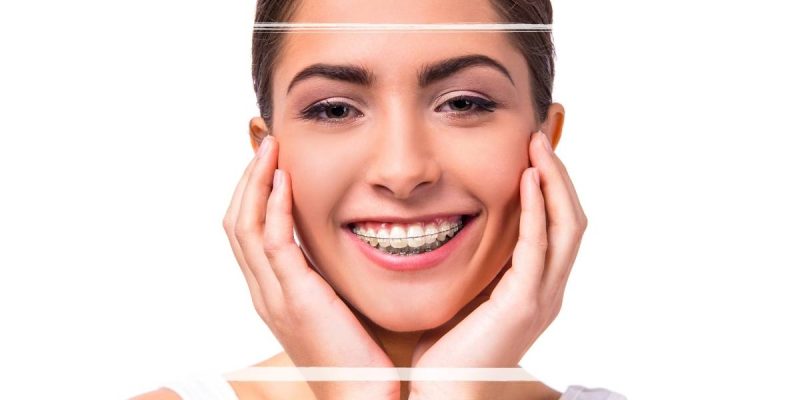 Power Chain Braces 15 What Are Power Chains On Braces For? Orthodontist Explains