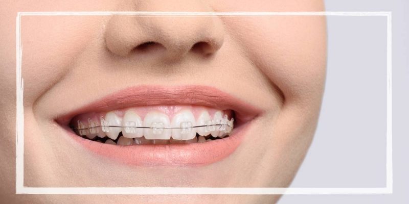 Power Chain Braces 17 When Do You Get Power Chain Braces? Orthodontist Explains